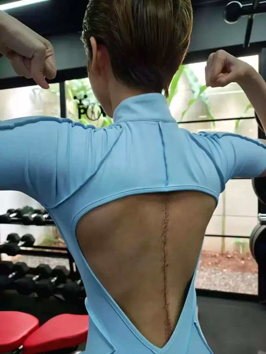 Dikenal Selalu Bugar dan Ceria, Nada Tarina Putri Corbuzier Ternyata Idap Skoliosis Parah, Begini Kondisinya! Luka sayatan operasi skoliosis nada