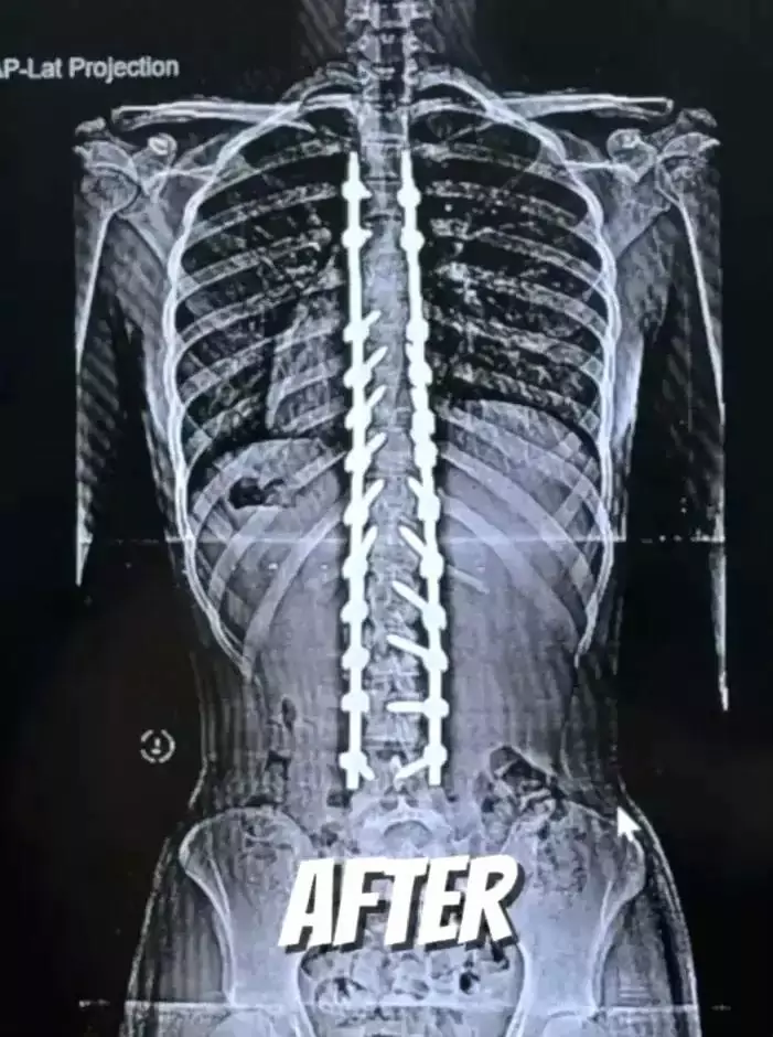 Nada after skoliosis surgery