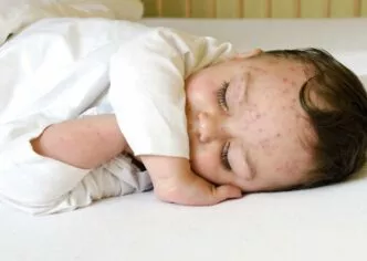 Cacar air pada bayi penyebab ciri ciri dan cara mengatasinya