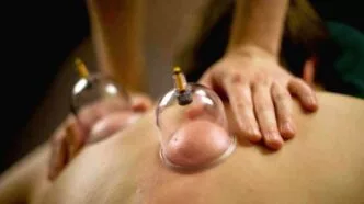 Terapi bekam manfaat dan efek sampingnya