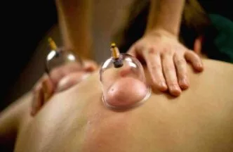 Terapi bekam manfaat dan efek sampingnya