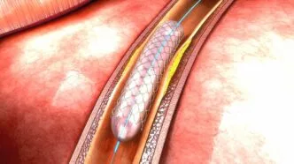 Stenting karotis prosedur pelebaran pembuluh darahjpg