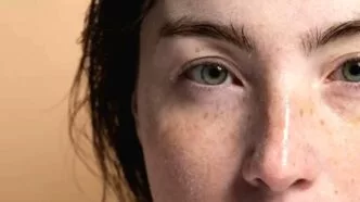 Menghilangkan flek hitam menurut dokter medis