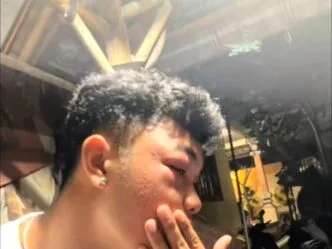Tanpa Alat Pelindung, Pemuda di Bali Diserang Tawon Saat Coba Musnahkan Sarang di Atap Rumah